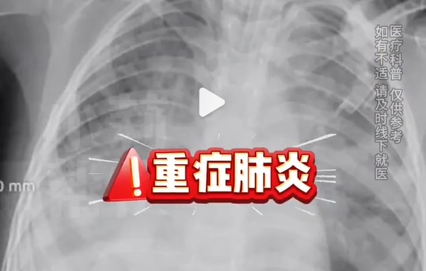 4歲女童甲流合并細菌感染肺都白了